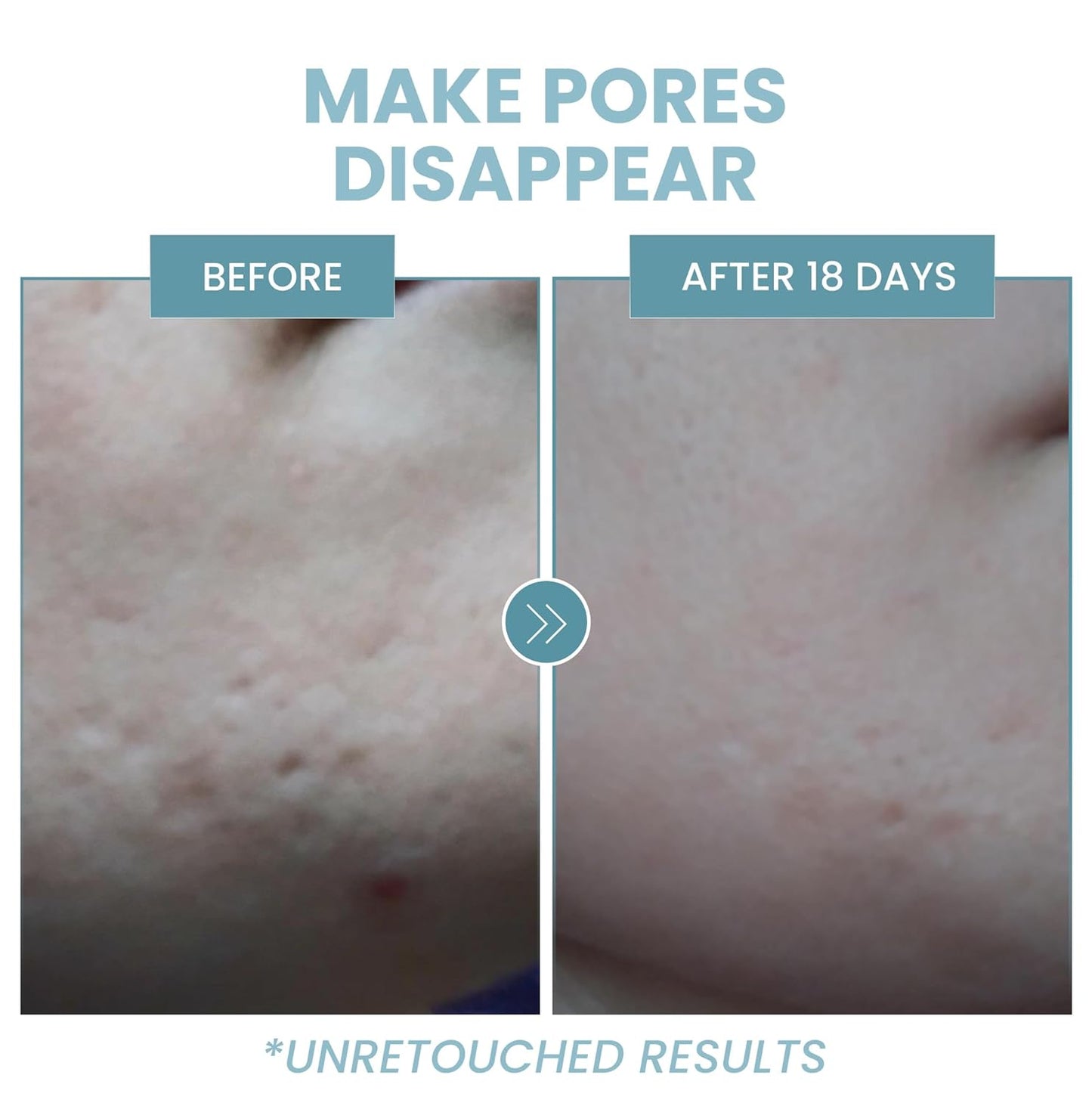 Eva Naturals Niacinamide 5% Serum for Face – B3 Pore Minimizer, Acne Treatment & Dark Spot Corrector with Hyaluronic Acid, Vitamin E, Aloe & Neem – Anti-Aging, Non-Greasy, Hydrating, 2oz